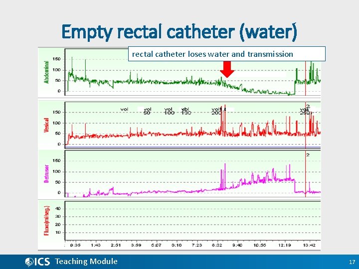 Empty rectal catheter (water) rectal catheter loses water and transmission Teaching Module 17 