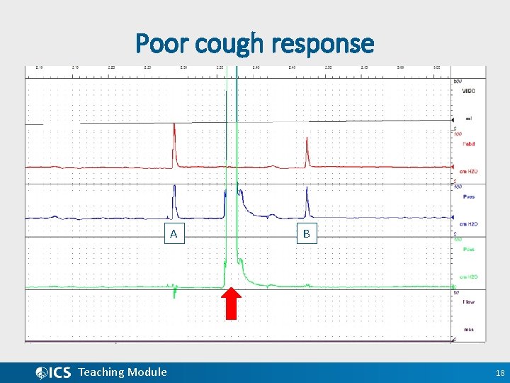 Poor cough response A Teaching Module B 18 
