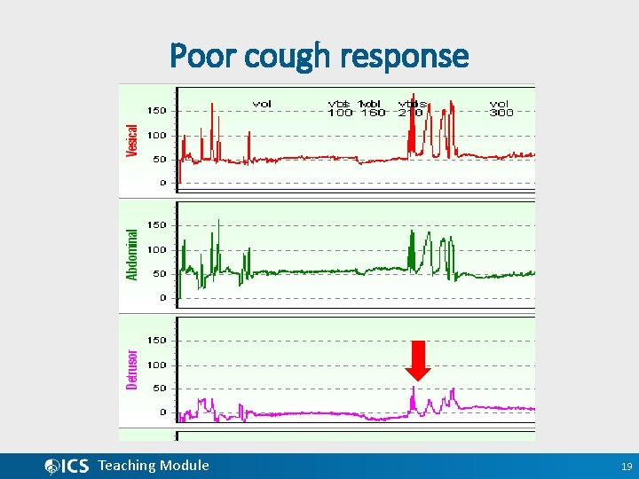 Poor cough response Teaching Module 19 