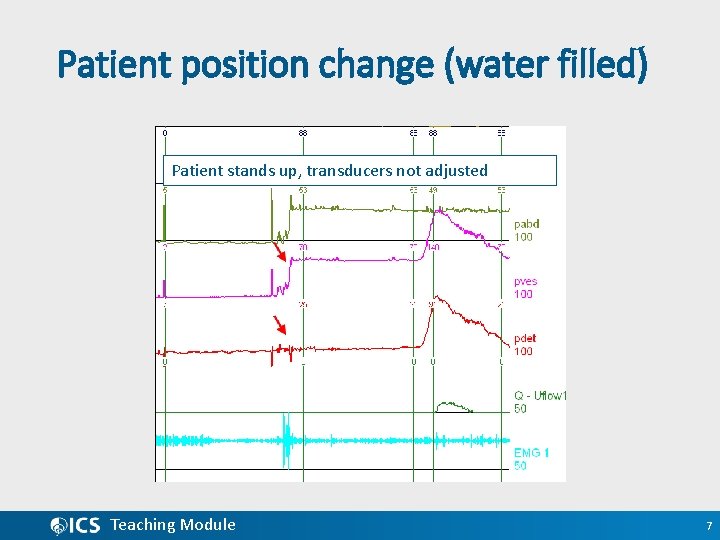 Patient position change (water filled) Patient stands up, transducers not adjusted Teaching Module 7