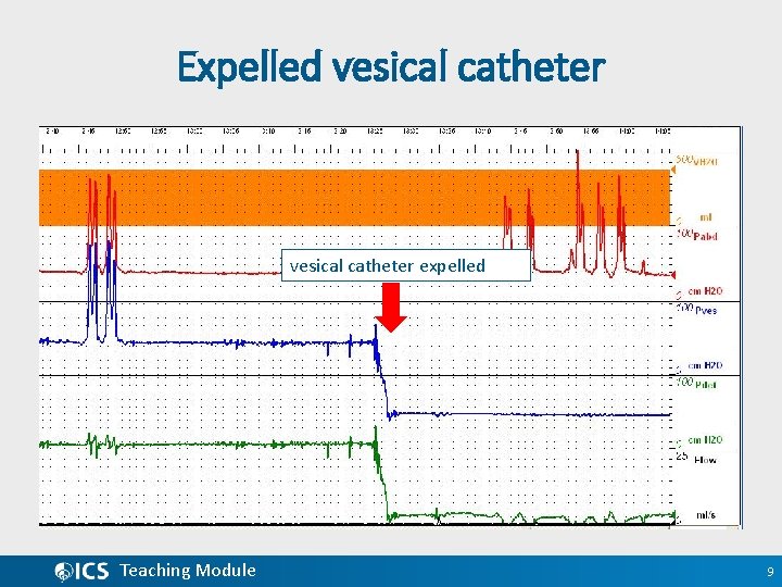Expelled vesical catheter expelled Teaching Module 9 