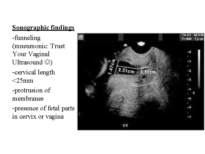 Sonographic findings -funneling (mneumonic: Trust Your Vaginal Ultrasound ) -cervical length <25 mm -protrusion