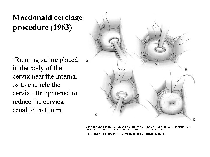 Macdonald cerclage procedure (1963) -Running suture placed in the body of the cervix near