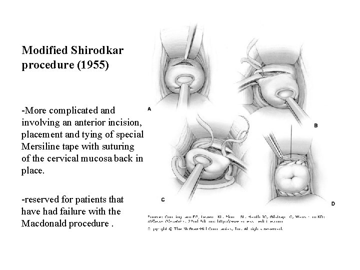 Modified Shirodkar procedure (1955) -More complicated and involving an anterior incision, placement and tying