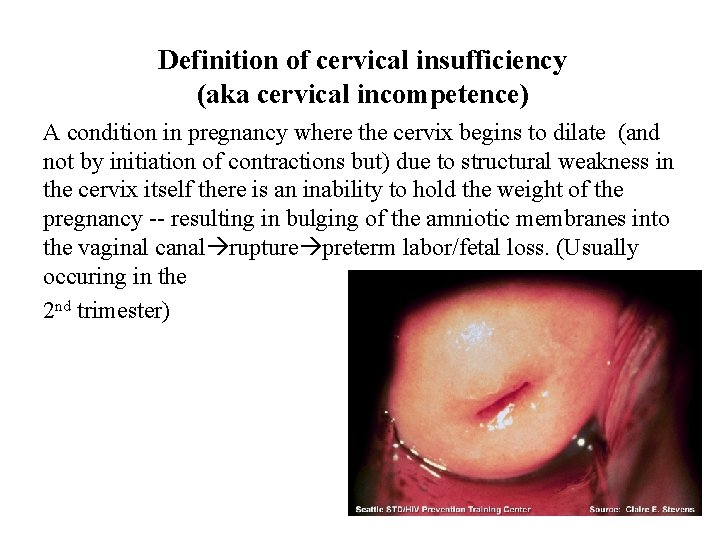 Definition of cervical insufficiency (aka cervical incompetence) A condition in pregnancy where the cervix
