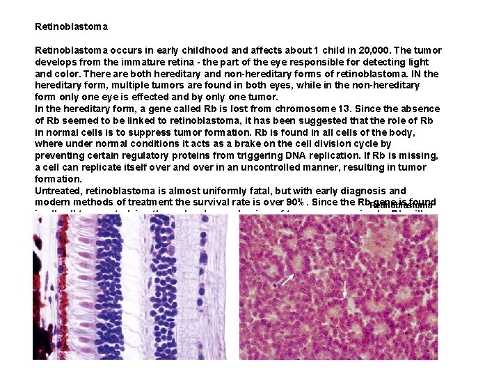 Retinoblastoma occurs in early childhood and affects about 1 child in 20, 000. The