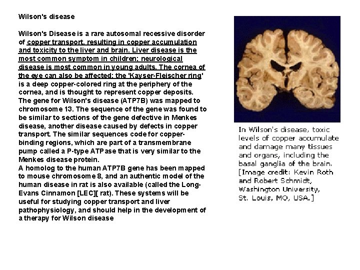 Wilson's disease Wilson's Disease is a rare autosomal recessive disorder of copper transport, resulting