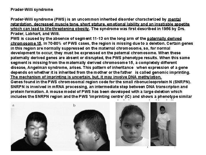 Prader-Willi syndrome (PWS) is an uncommon inherited disorder characterized by mental retardation, decreased muscle