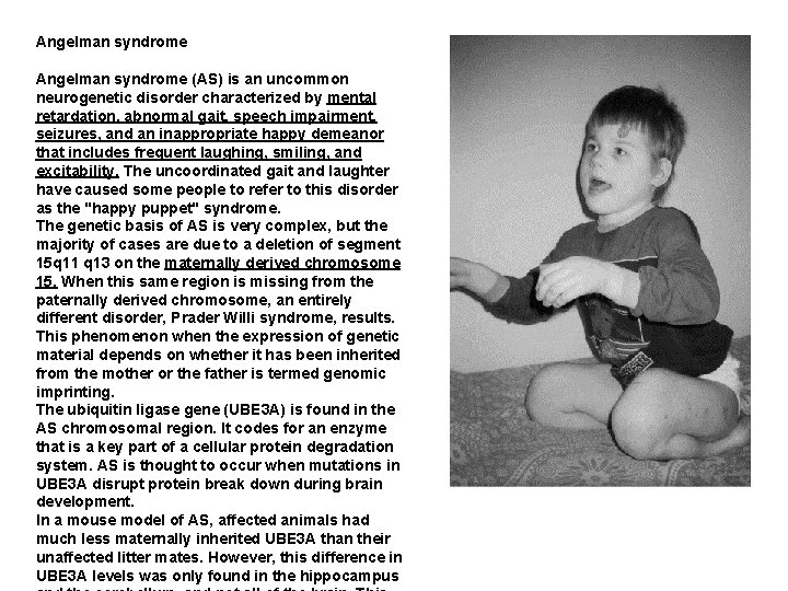 Angelman syndrome (AS) is an uncommon neurogenetic disorder characterized by mental retardation, abnormal gait,