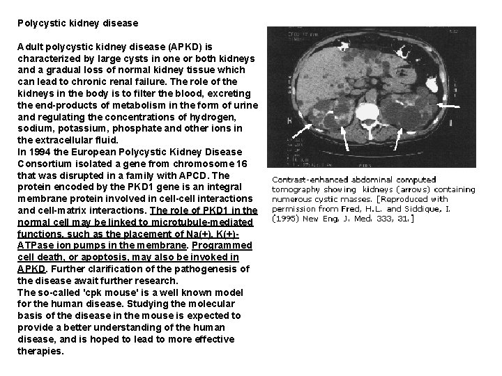 Polycystic kidney disease Adult polycystic kidney disease (APKD) is characterized by large cysts in