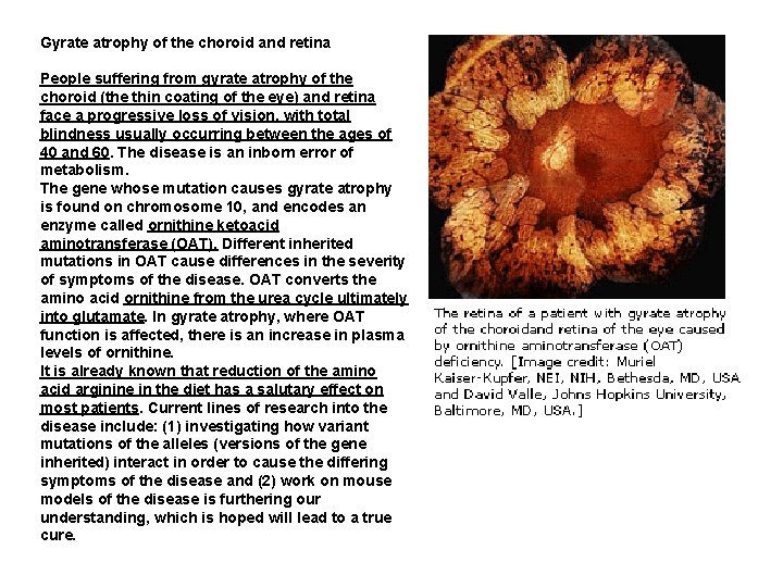 Gyrate atrophy of the choroid and retina People suffering from gyrate atrophy of the