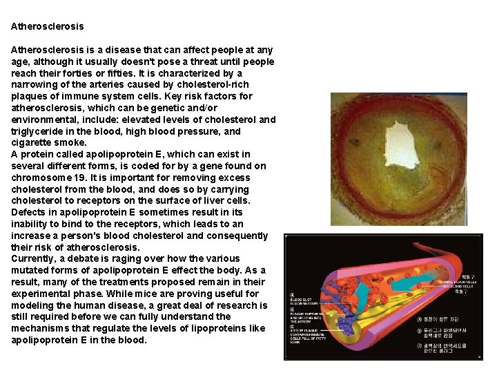 Atherosclerosis is a disease that can affect people at any age, although it usually