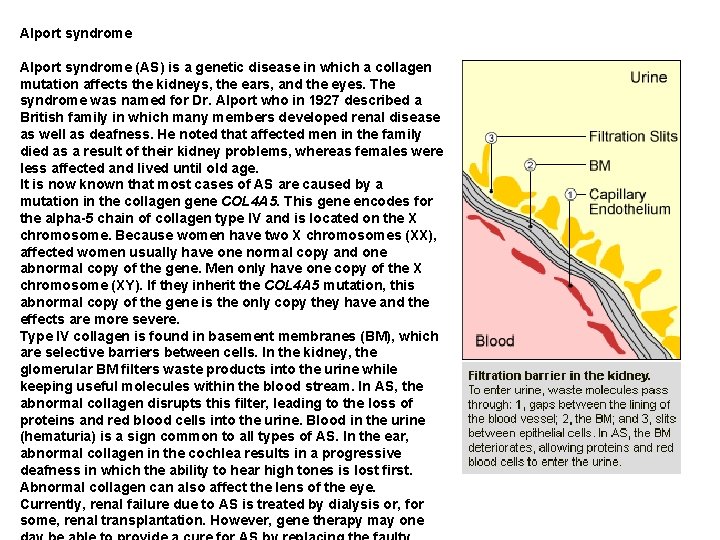 Alport syndrome (AS) is a genetic disease in which a collagen mutation affects the