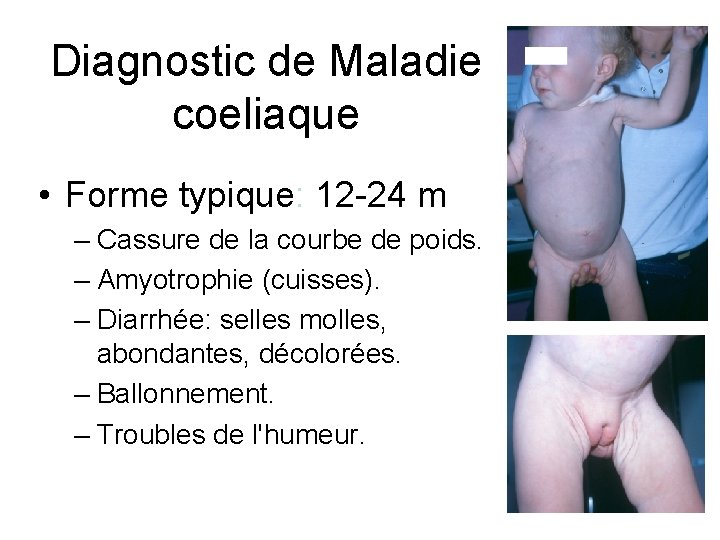 Diagnostic de Maladie coeliaque • Forme typique: 12 -24 m – Cassure de la