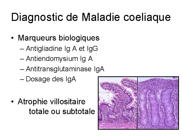 Diagnostic de Maladie coeliaque • Marqueurs biologiques – Antigliadine Ig A et Ig. G