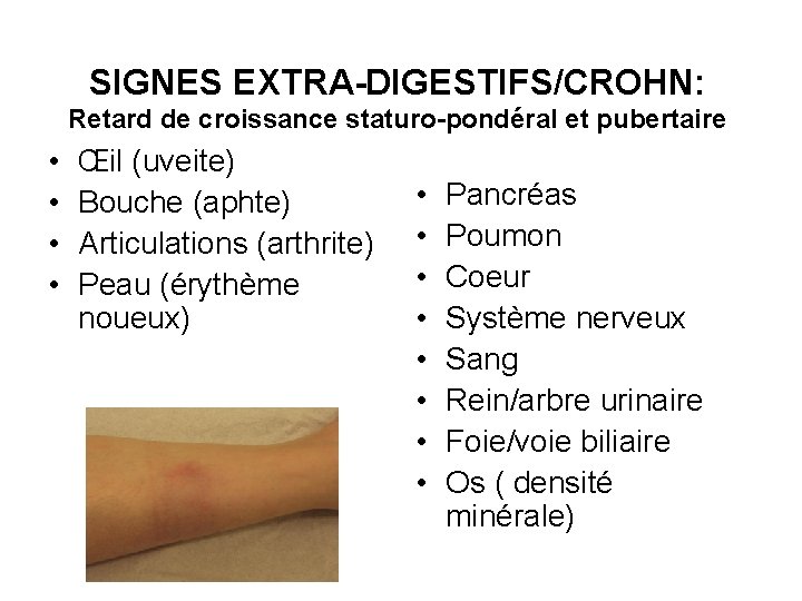 SIGNES EXTRA-DIGESTIFS/CROHN: Retard de croissance staturo-pondéral et pubertaire • • Œil (uveite) Bouche (aphte)