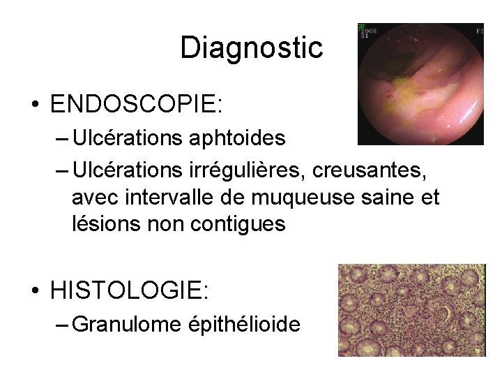 Diagnostic • ENDOSCOPIE: – Ulcérations aphtoides – Ulcérations irrégulières, creusantes, avec intervalle de muqueuse