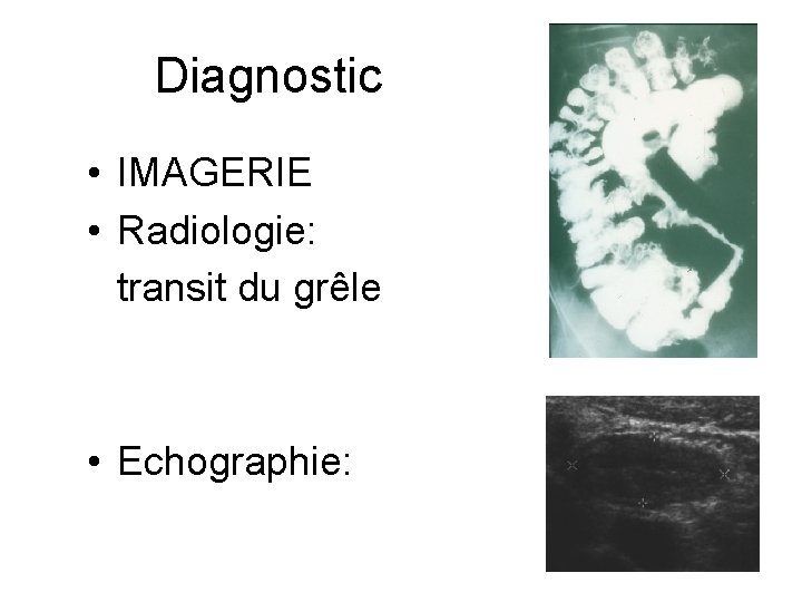 Diagnostic • IMAGERIE • Radiologie: transit du grêle • Echographie: 