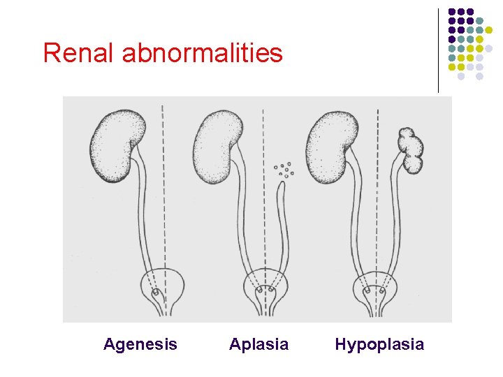 Renal abnormalities Agenesis Aplasia Hypoplasia 