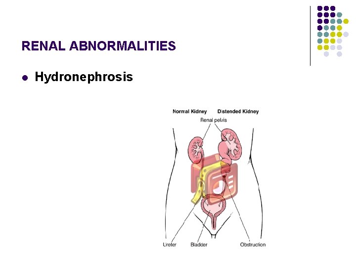 RENAL ABNORMALITIES l Hydronephrosis 