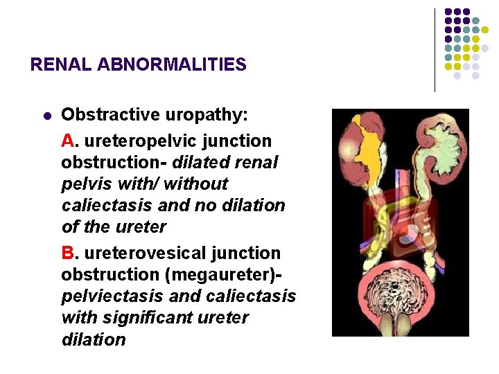 RENAL ABNORMALITIES l Obstractive uropathy: A. ureteropelvic junction obstruction- dilated renal pelvis with/ without