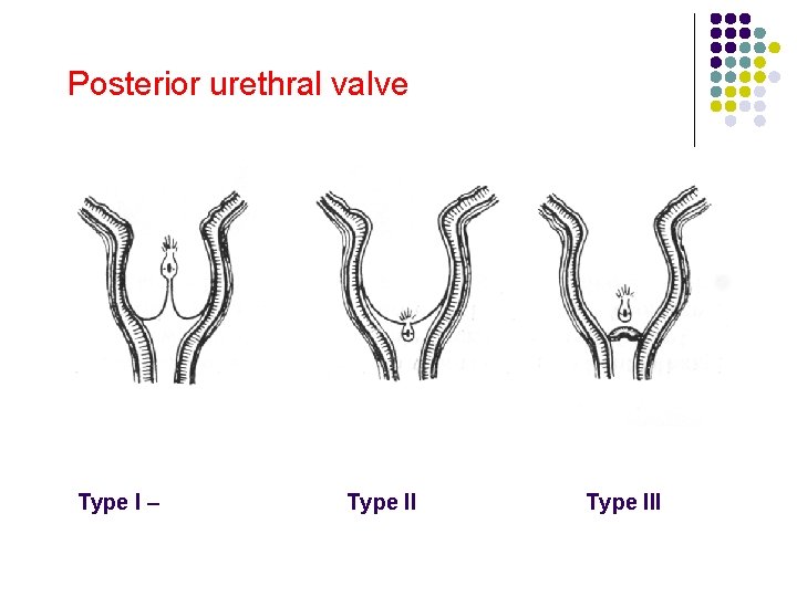 Posterior urethral valve Type I – Type III 