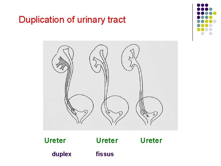 Duplication of urinary tract Ureter duplex Ureter fissus Ureter 