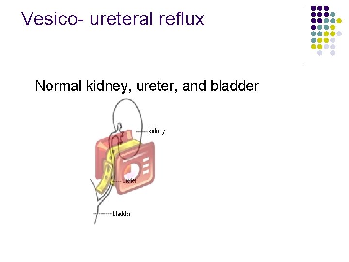 Vesico- ureteral reflux Normal kidney, ureter, and bladder 