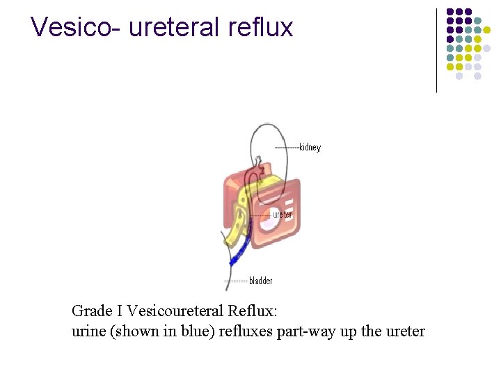 Vesico- ureteral reflux Grade I Vesicoureteral Reflux: urine (shown in blue) refluxes part-way up