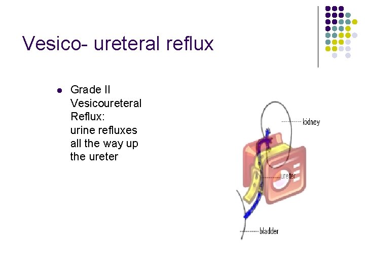 Vesico- ureteral reflux l Grade II Vesicoureteral Reflux: urine refluxes all the way up