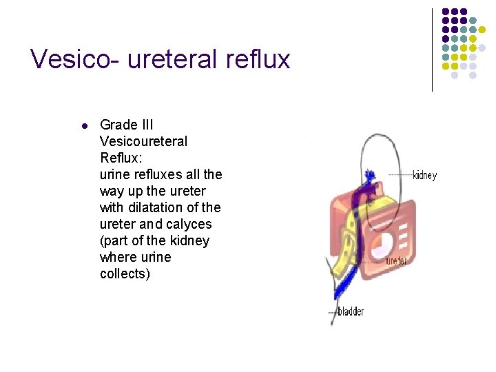 Vesico- ureteral reflux l Grade III Vesicoureteral Reflux: urine refluxes all the way up