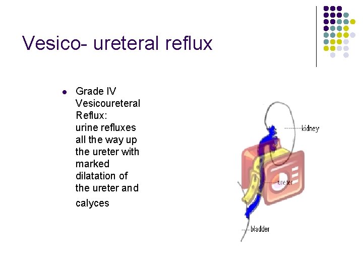 Vesico- ureteral reflux l Grade IV Vesicoureteral Reflux: urine refluxes all the way up