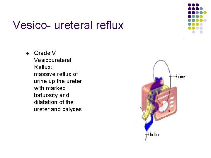 Vesico- ureteral reflux l Grade V Vesicoureteral Reflux: massive reflux of urine up the