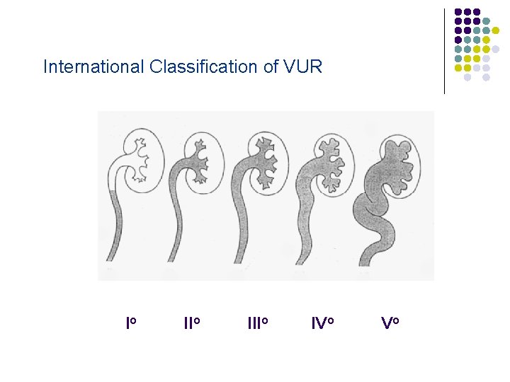 International Classification of VUR Io IIIo IVo Vo 