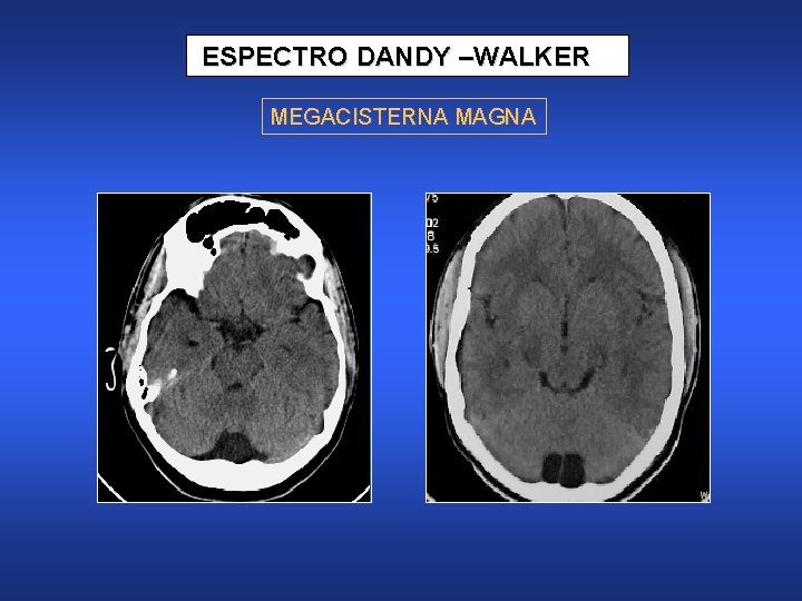 ESPECTRO DANDY –WALKER MEGACISTERNA MAGNA 