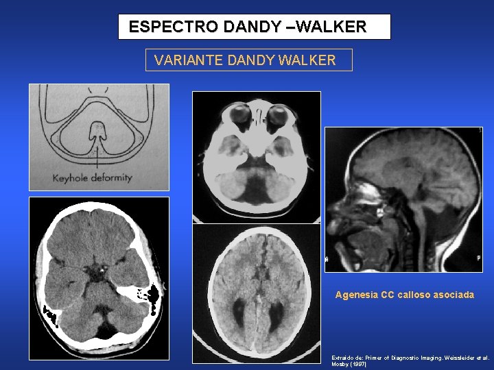 ESPECTRO DANDY –WALKER VARIANTE DANDY WALKER Agenesia CC calloso asociada Extraído de: Primer of