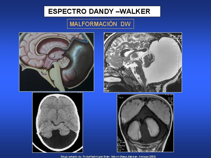 ESPECTRO DANDY –WALKER MALFORMACIÓN DW Dibujo extraído de: Pocket. Radiologist: Brain. Osborn, Blaser, Salzman.