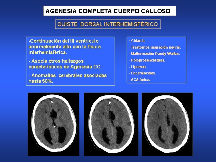 AGENESIA COMPLETA CUERPO CALLOSO QUISTE DORSAL INTERHEMISFÉRICO -Continuación del III ventrículo anormalmente alto con