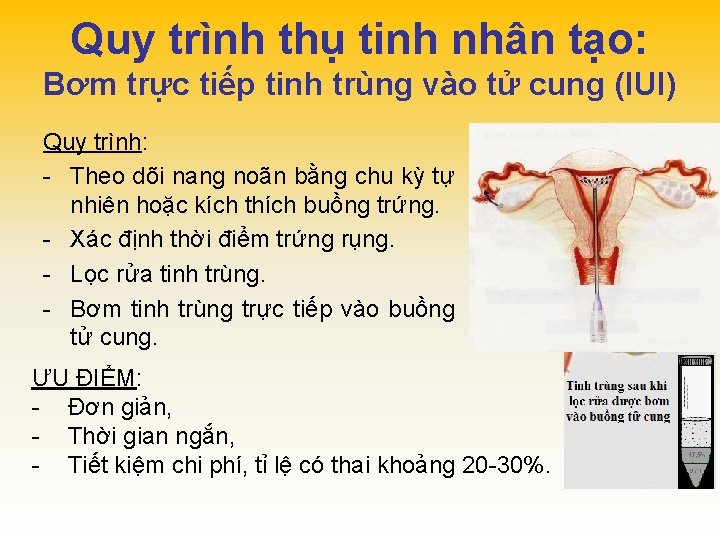 Quy trình thụ tinh nhân tạo: Bơm trực tiếp tinh trùng vào tử cung