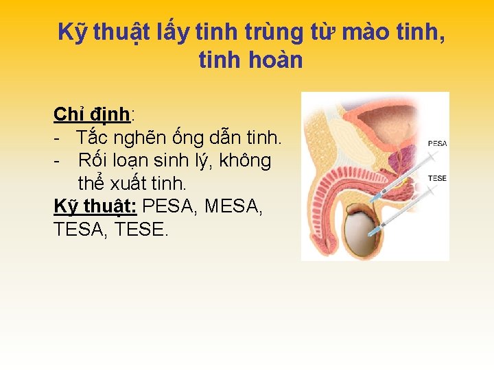 Kỹ thuật lấy tinh trùng từ mào tinh, tinh hoàn Chỉ định: - Tắc