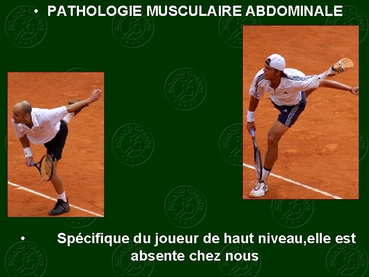  • PATHOLOGIE MUSCULAIRE ABDOMINALE • Spécifique du joueur de haut niveau, elle est