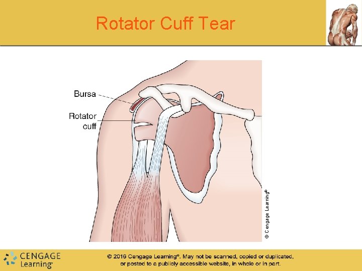 © Cengage Learning® Rotator Cuff Tear © Cengage Learning® Rotator Cuff Tear