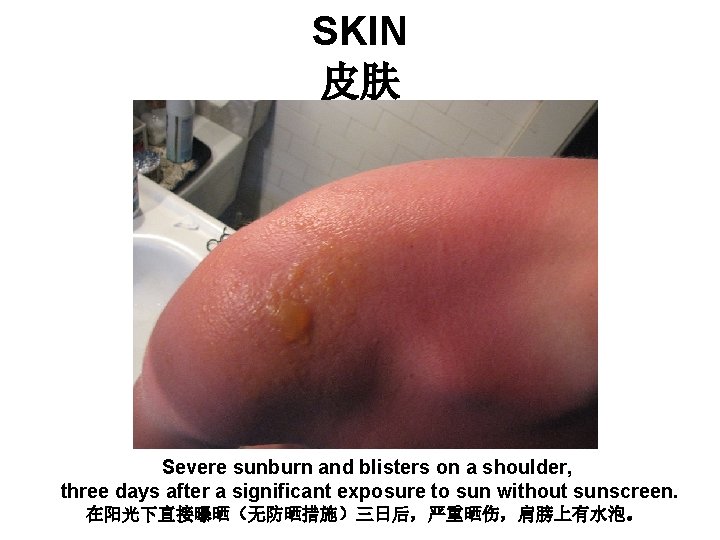 SKIN 皮肤 Severe sunburn and blisters on a shoulder, three days after a significant SKIN 皮肤 Severe sunburn and blisters on a shoulder, three days after a significant