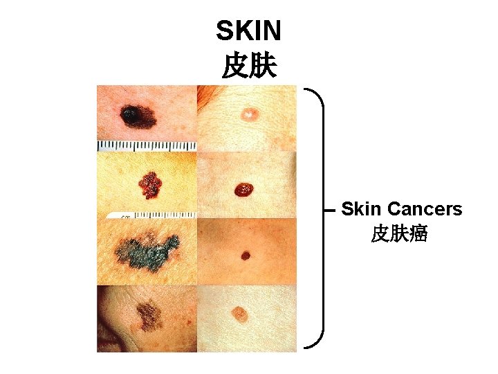 SKIN 皮肤 Skin Cancers 皮肤癌 SKIN 皮肤 Skin Cancers 皮肤癌