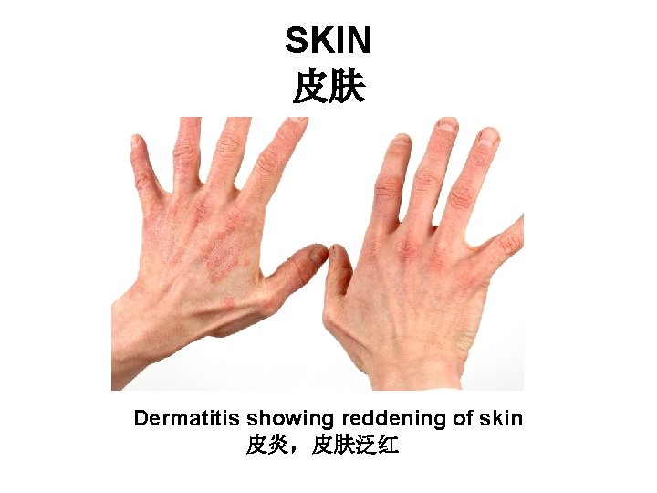 SKIN 皮肤 Dermatitis showing reddening of skin 皮炎,皮肤泛红 SKIN 皮肤 Dermatitis showing reddening of skin 皮炎,皮肤泛红