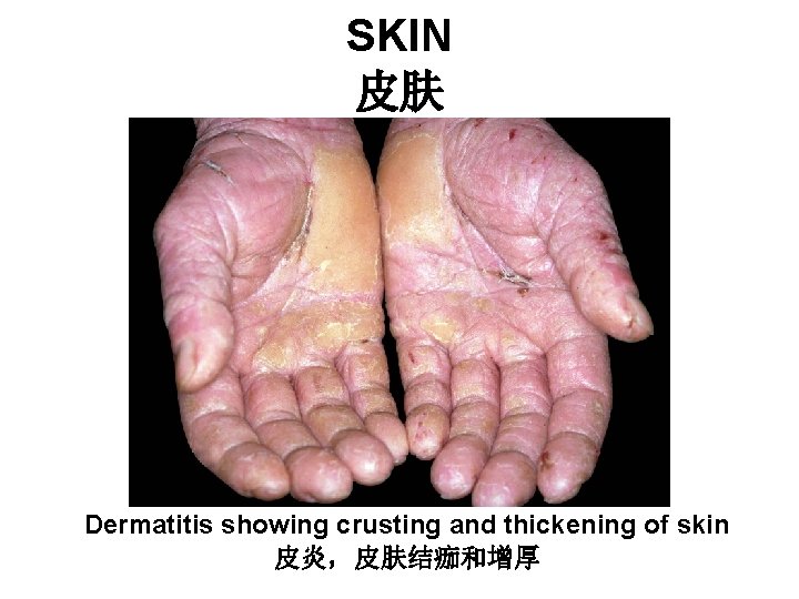SKIN 皮肤 Dermatitis showing crusting and thickening of skin 皮炎,皮肤结痂和增厚 SKIN 皮肤 Dermatitis showing crusting and thickening of skin 皮炎,皮肤结痂和增厚