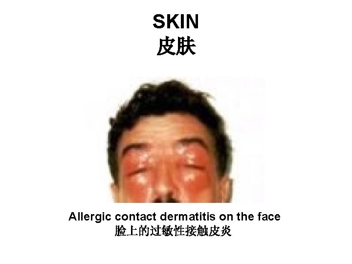 SKIN 皮肤 Allergic contact dermatitis on the face 脸上的过敏性接触皮炎 SKIN 皮肤 Allergic contact dermatitis on the face 脸上的过敏性接触皮炎