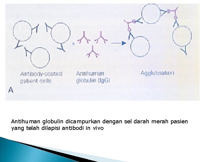 Antihuman globulin dicampurkan dengan sel darah merah pasien yang telah dilapisi antibodi in vivo