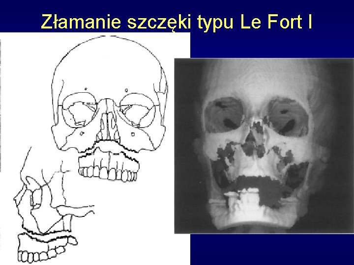 Złamanie szczęki typu Le Fort I 