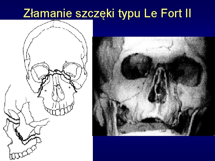 Złamanie szczęki typu Le Fort II 